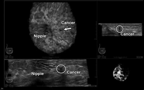 Can an Ultrasound Show Cancer? Exploring the Boundaries of Medical Imaging and Beyond